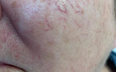 Thread Veins: Aesthetic treatment