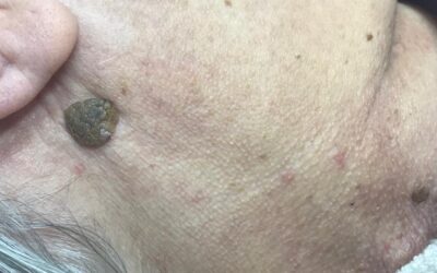 Seborrhoeic Keratosis: Aesthetic Treatment