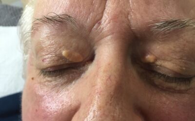 Xanthelasma: Aesthetic treatments