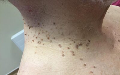 Skin Tags: Aesthetic treatment